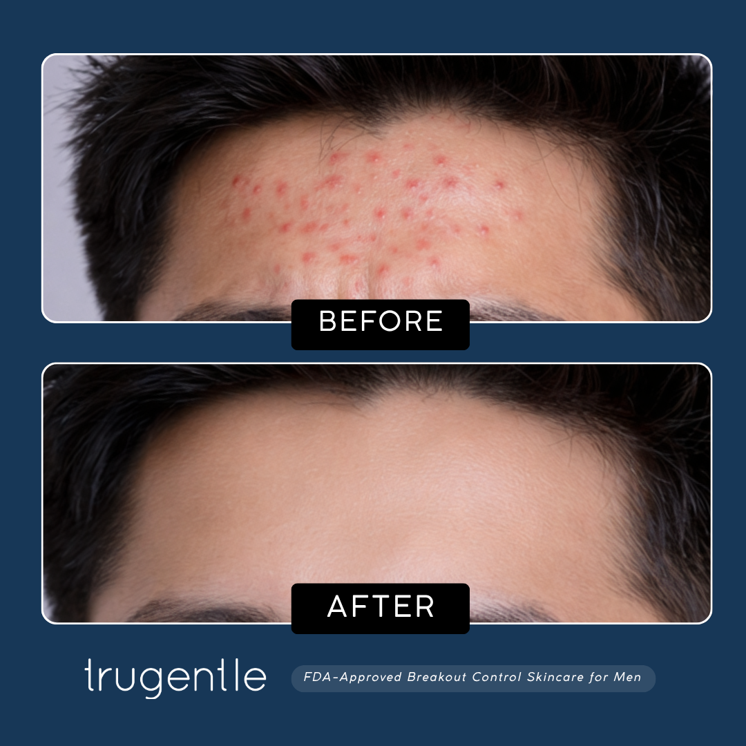 TruGentle Breakout Control Kit