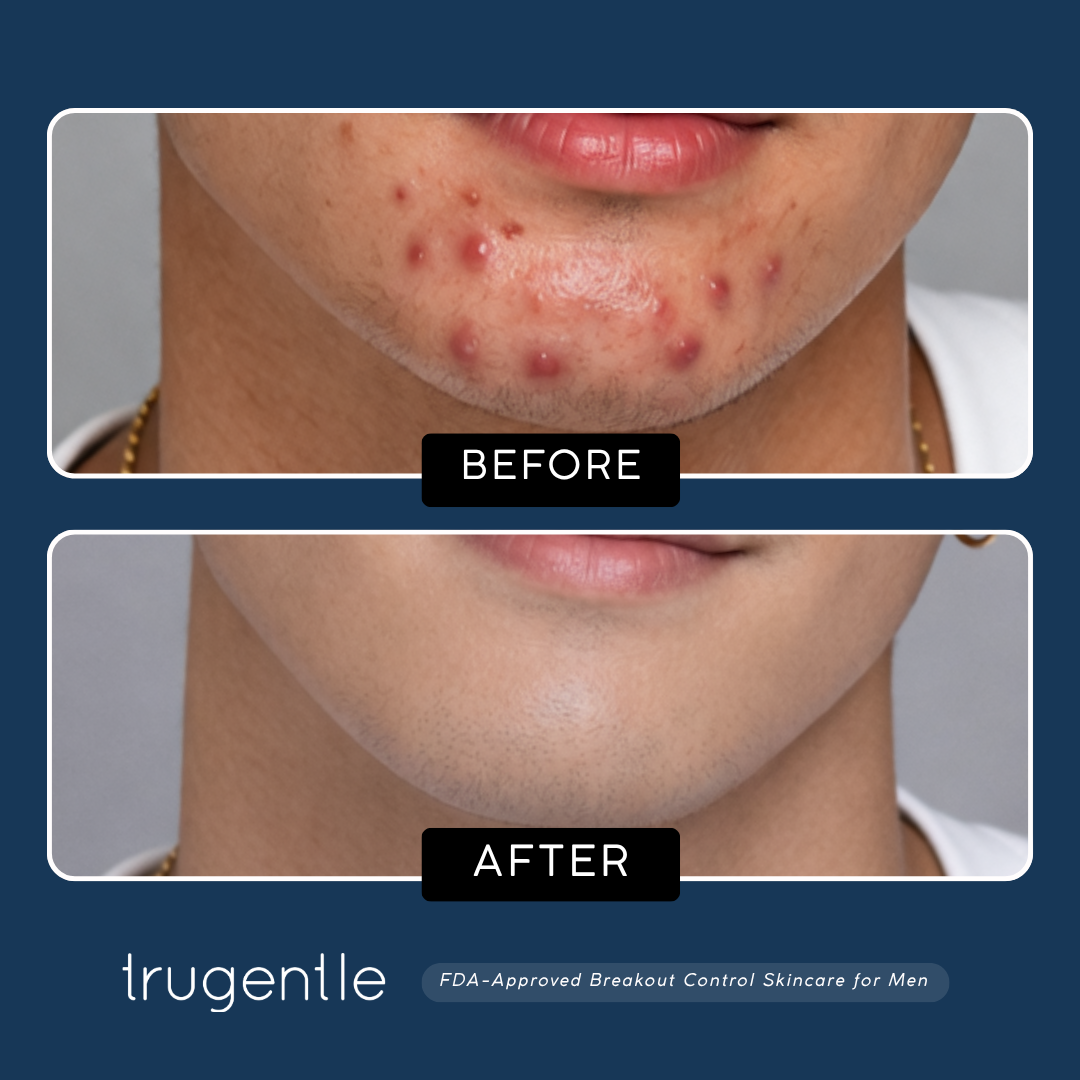 TruGentle Breakout Control Kit