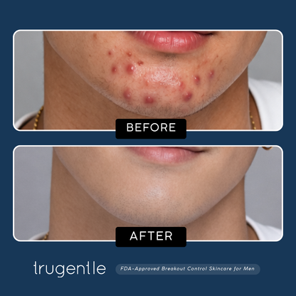 TruGentle Breakout Control Kit