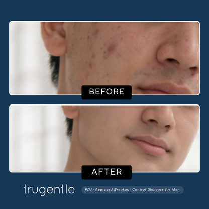 TruGentle Breakout Control Kit